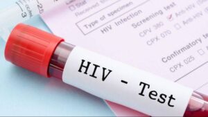 dunyada 408 milyon kisi hiv ile yasiyor turkiyede artis suruyor MDCpm89b.jpg